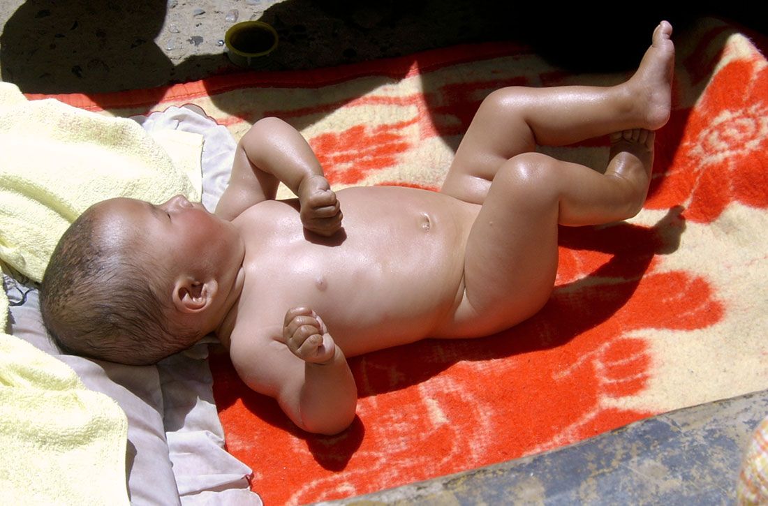 infant sunbathing for rickets prevention